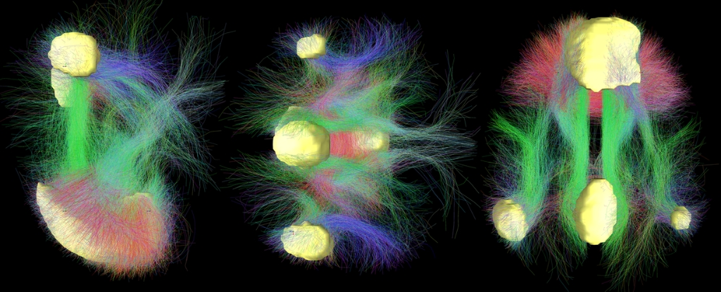Study of 6,000 Scans Reveals Brain-Wide Patterns Linked to ADHD Symptoms
