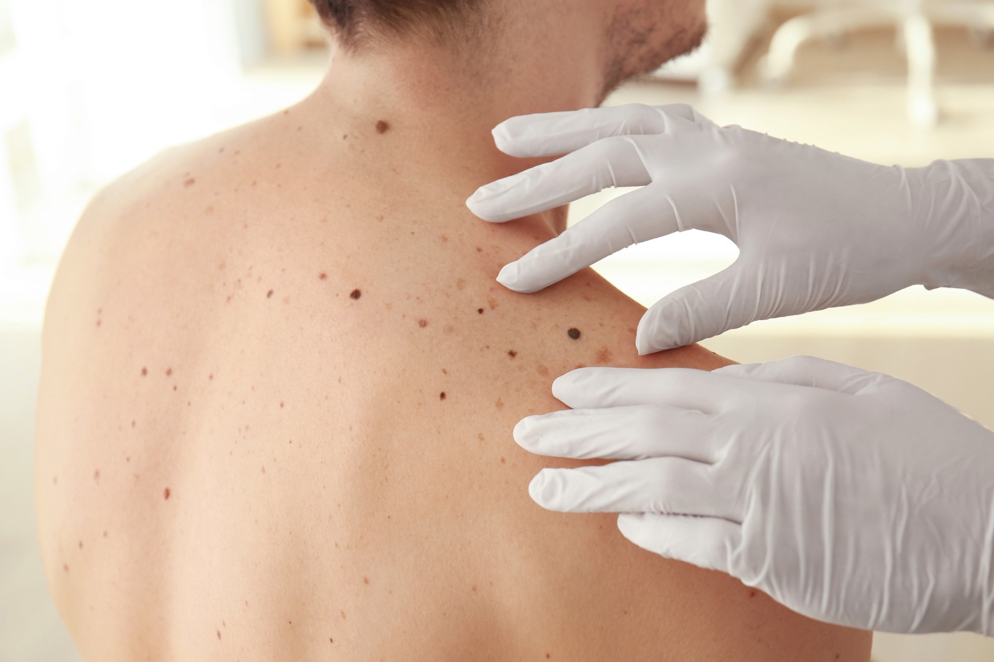 Advanced melanoma survival rates improve significantly from 2013 to 2019, Dutch study finds