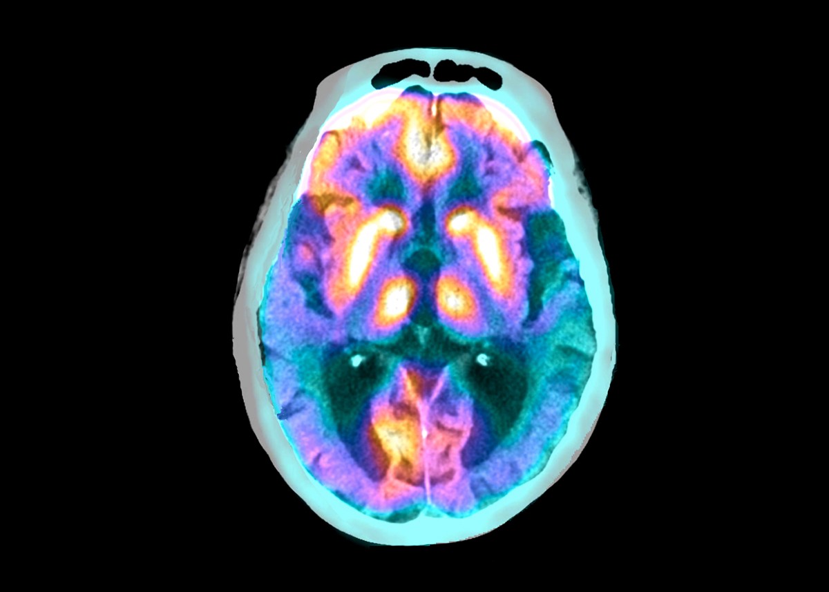 Alzheimer’s drug with modest benefits wins backing of FDA advisers