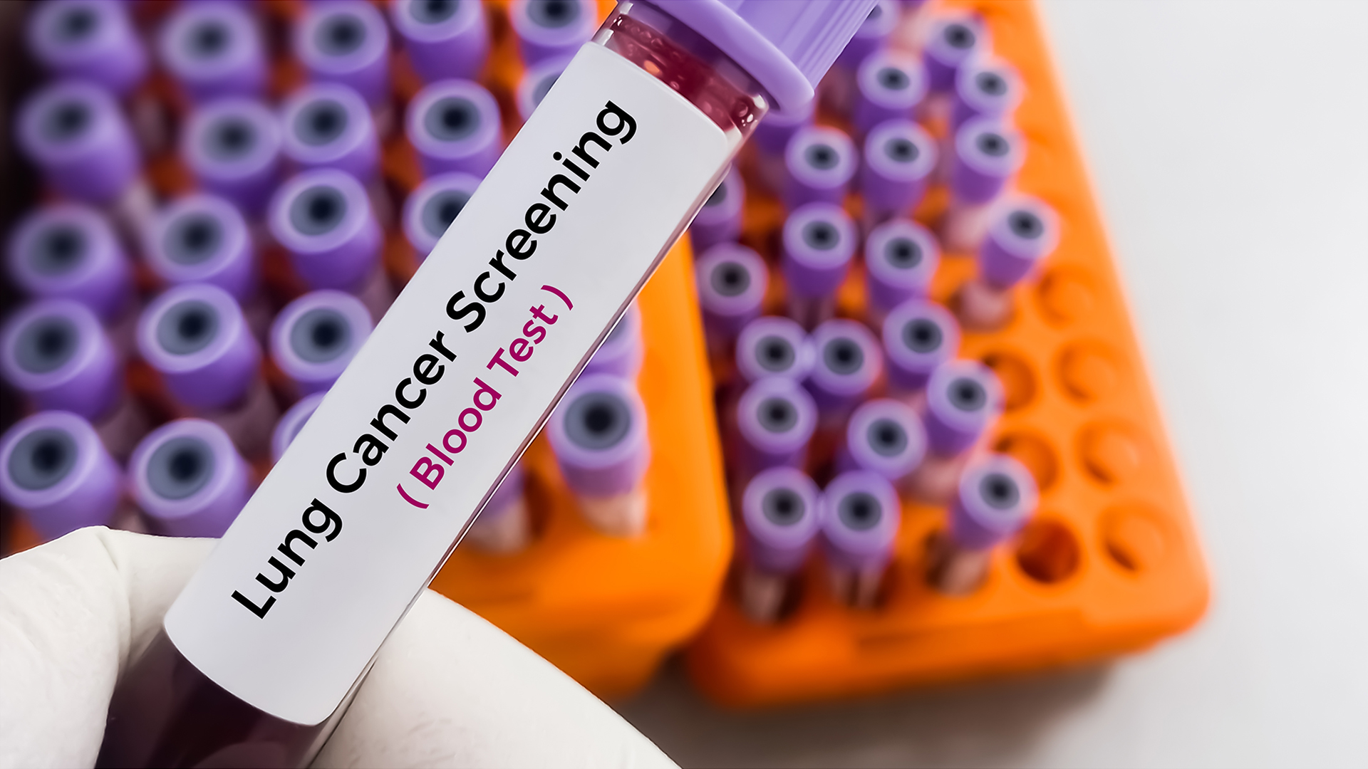 Researchers develop AI blood test to diagnose lung cancer